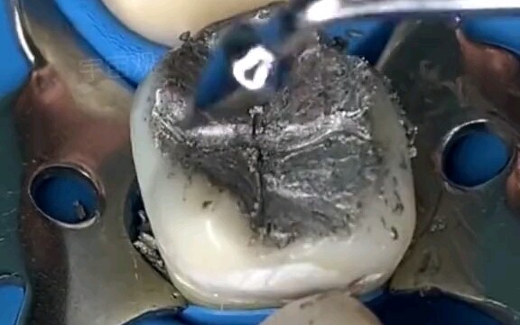 Dental filling materials ten years ago