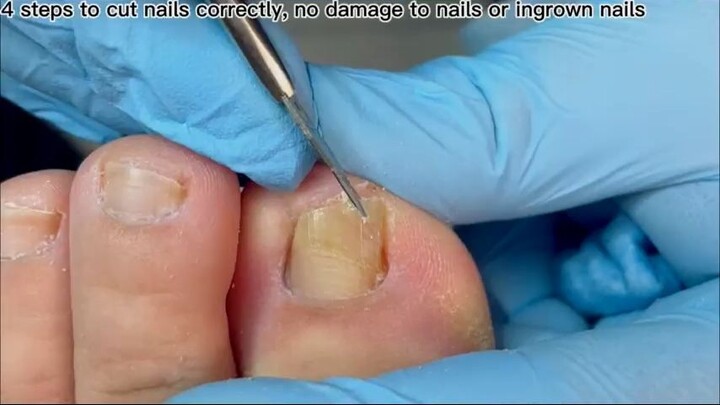 No problem, fix a blackened toenail on one side_R