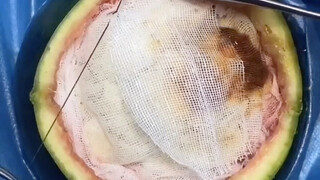 Semangka mengalami pendarahan otak dan harus segera dioperasi!