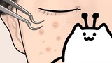 [Animation][Skin Care]How to get rid of blackheads