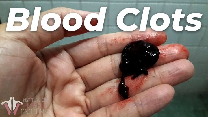 Why Blood Clots Are So Incredibly Dangerous...