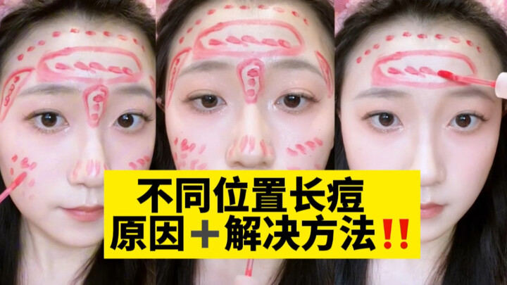 Nguyên nhân và cách xử lý mụn ở các vị trí khác nhau, xem hết tập này là đủ!