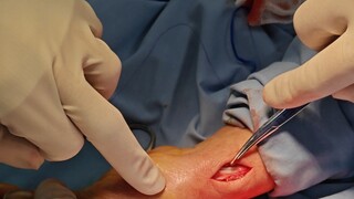 กล้ามเนื้อทอดยาวฝ่ามือ กล้ามเนื้อยืดนิ้วหัวแม่มือสั้น ศาสตราจารย์ชวี ฮังปัว