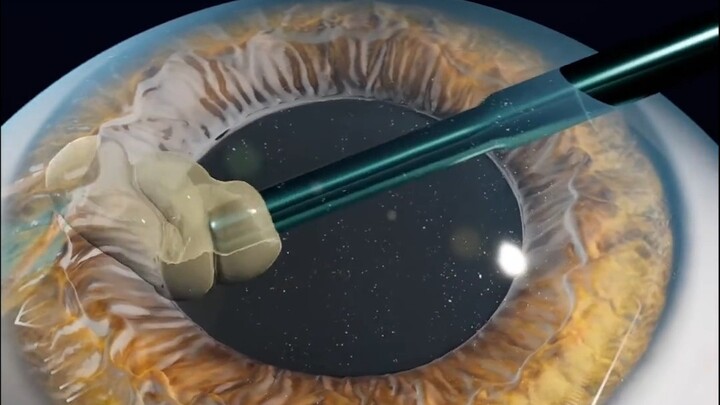 Principles of Cataract Surgery