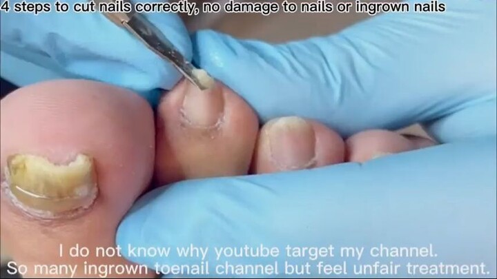 Little bit thick toenail treatment - Copy_R