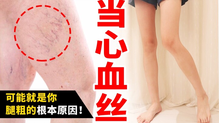 【เส้นเลือดฝอยที่ขา】อาจเป็นสาเหตุหลักที่ทำให้ต้นขา/น่องใหญ่! พร้อมแนวทางแก้ไข