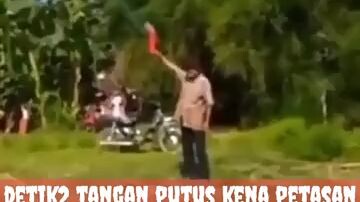 tangan putus kena petasan😨