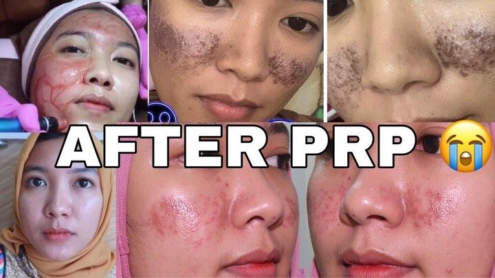 Aku Trauma PRP, Penyembuhan Luka Treatment PRP/Facial Vampire, kok malah ninggalin bekas?