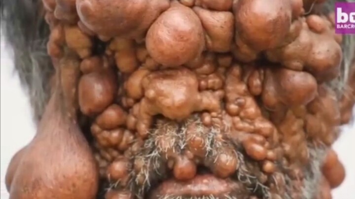 深受神经纤维瘤影响的患者，慎看