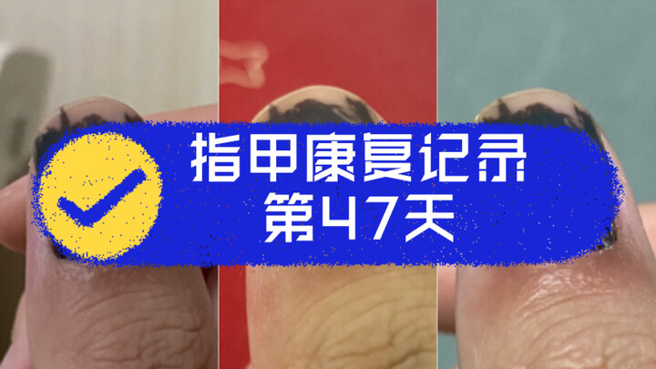 Ngày thứ 47, cuối cùng cũng đủ can đảm để phẫu thuật, rạch ra!