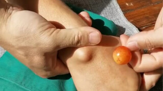 妙杀腱鞘囊肿