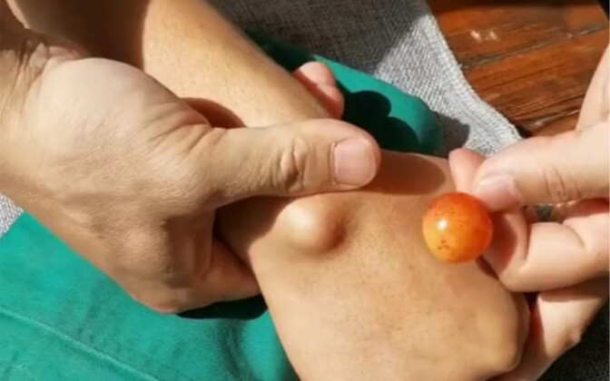 妙杀腱鞘囊肿