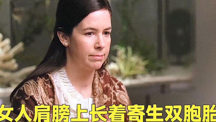 Di bahu wanita itu tumbuh seorang adik kembar parasit.