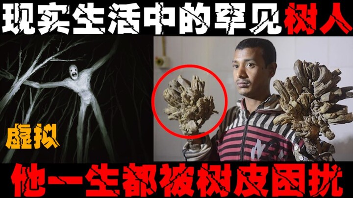 【Manusia Pohon Nyata】Jangan masuk jika takut ruang sempit! Kulit pohon terus tumbuh di tubuhnya, ia 