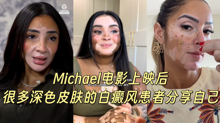 TikTok: What does vitiligo look like on people with dark skin?