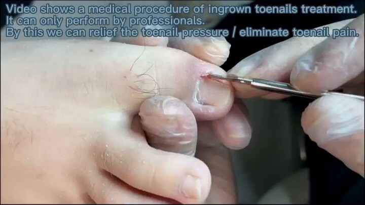 Pedicure Tutorial  Removal Broken big nail_R
