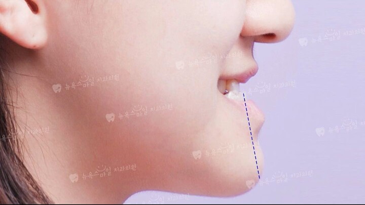 非手术地包天矫正的核心