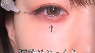 The Beauty Point Injection Technique for Under-Eye Bags