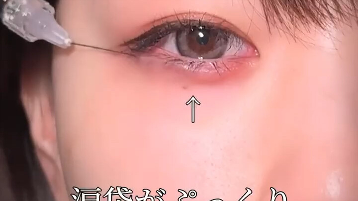 The Beauty Point Injection Technique for Under-Eye Bags