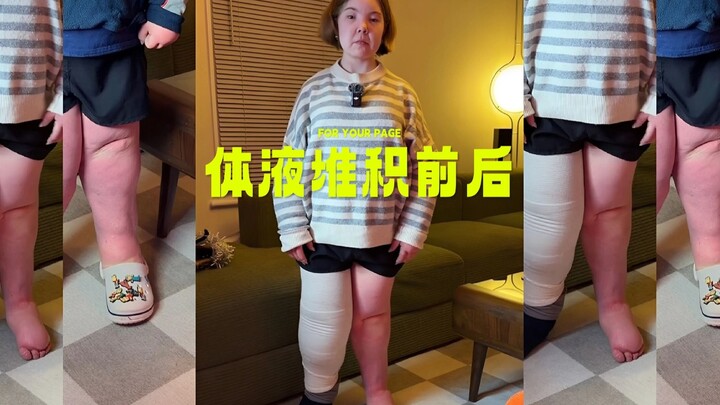 If I don’t wear my compression garment for 24 hours, this is what my body will look like!