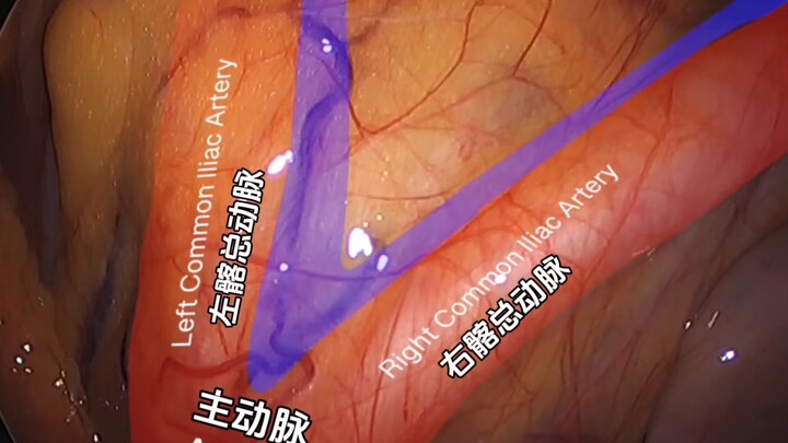 التعرف على تراكيب الحوض من منظور المنظار البطني
