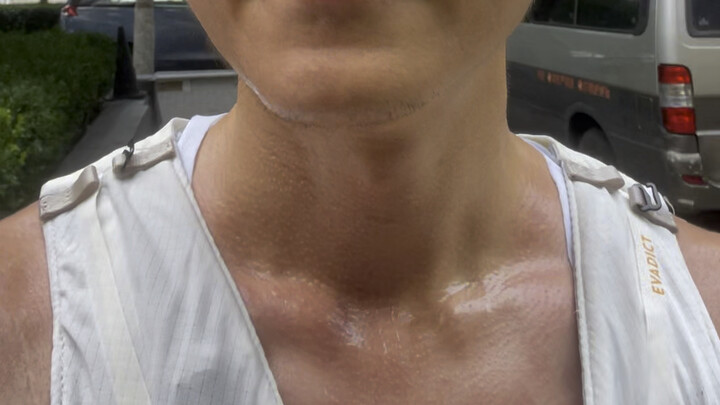 I was born with half my face unable to sweat… From the day I was born, my family sought treatment ev