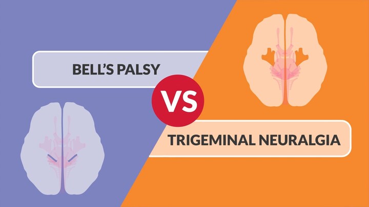 Bell's Palsy vs. Trigeminal Neuralgia