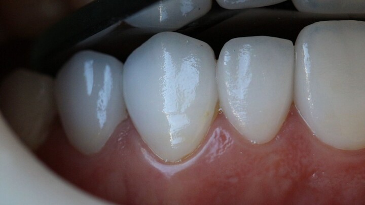 lente dental