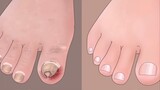 Satisfying ingrown toenail removal treatment