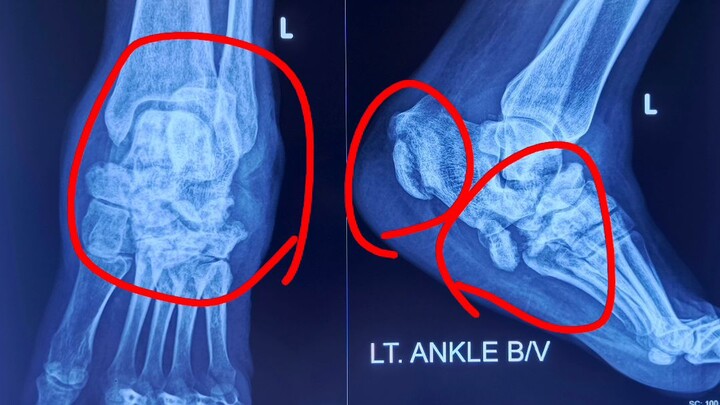 Left Ankle Both View: Old Fracture of Calcaneus and Cuboid with Diabetic Bone Changes
