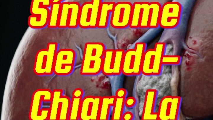 💊      Síndrome de Budd-Chiari: la circulación bloqueada