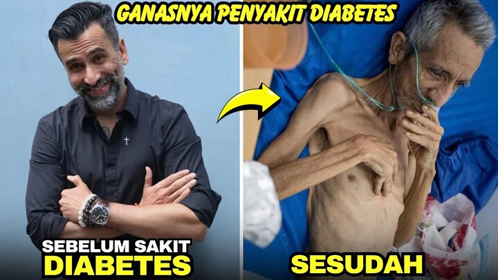 Jarang tersorot, 8 artis alami sakit diabetes berujung meninggal dunia