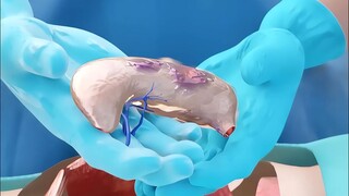 What? Stomach removal!