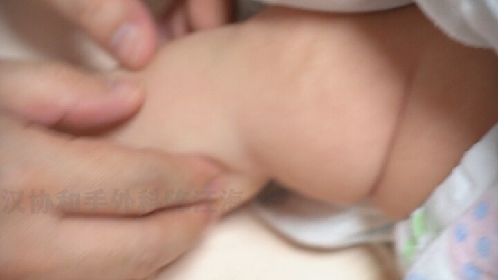 Mẹ cứ nghi ngờ vết hằn trên người bé là do đai quấn, đến khi nghe được lời khẳng định thì mới yên tâ