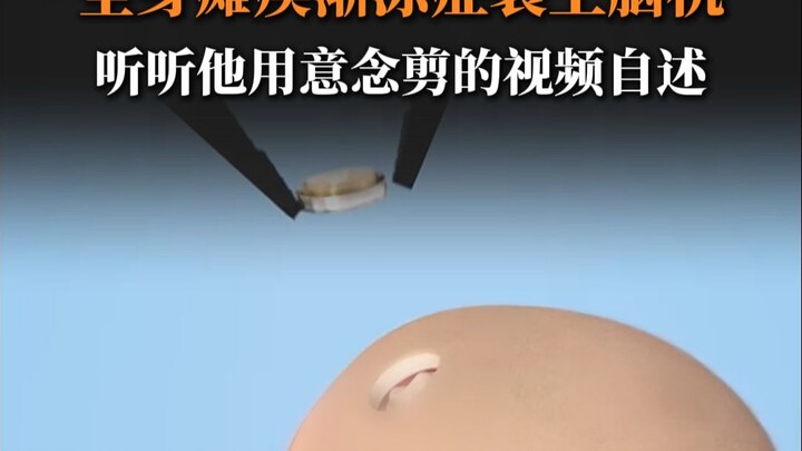 A patient with ALS who is completely paralyzed posts online using brain-computer interface technolog