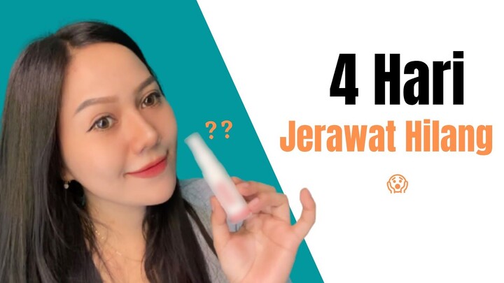 Jerawat Langsung Hilang Hanya pake Krim Ini??