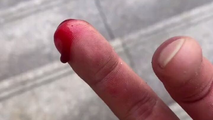 كنت أعرف أن الأصابع مرتبطة بالقلب، لكنني لم أتوقع أن الألم يكون بهذه الشدة #حديدٌ صلب