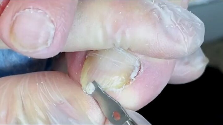 Pedicure Tutorial Step by step how to clean fungus toenail_R