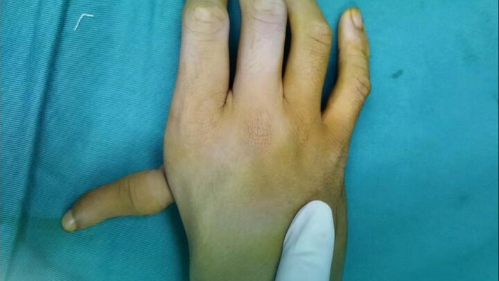 ไปหาหมอมาหลายโรงพยาบาลแล้ว ทุกที่บอกให้ตัดนิ้วโป้งออก แต่นิ้วใหญ่ขนาดนี้จะตัดทิ้งไปมันเสียดายมากเลย