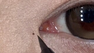 Akhirnya tahu di mana harus menggambar saat melakukan operasi blefaroplasti medial agar tidak terlih