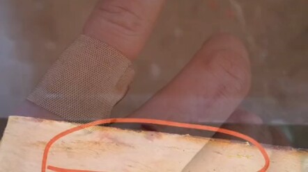 Chiếc nhẫn ngón út mà người đàn ông đeo sát mình suốt 10 năm đã cứu được bốn ngón tay của anh.