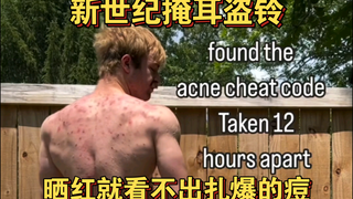 新世纪掩耳盗铃-晒红就看不出扎爆的痘