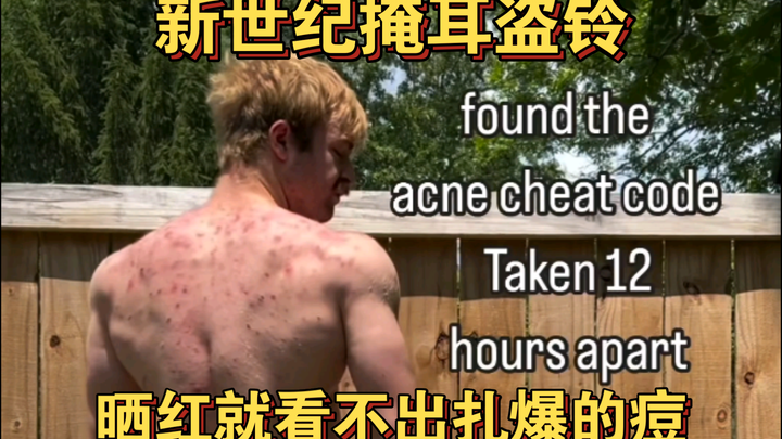 The New Century Cover-Up - Sunburn makes popped acne invisible