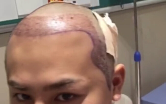 Bilibili’s “Baldest Boy” Gets a Hair Transplant—Kicked Out by His Family! The Full Record of His Hai