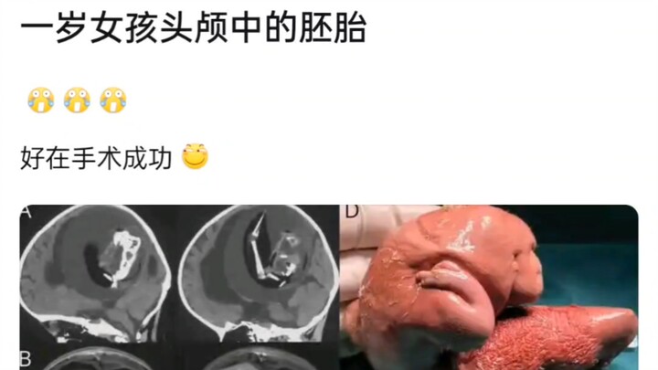 Embryo in a One-Year-Old Girl's Brain