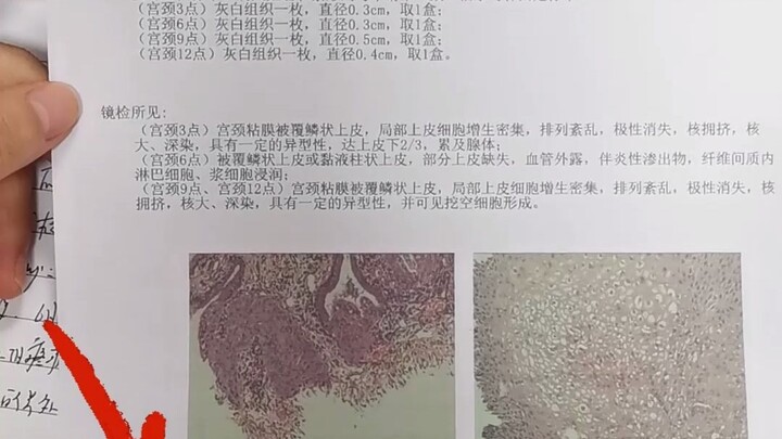HPV test report for early sexual activity