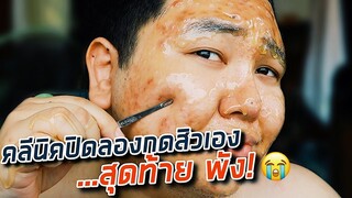 คลีนิคปิดลองกดสิวเอง...สุดท้ายพัง! | จือปาก