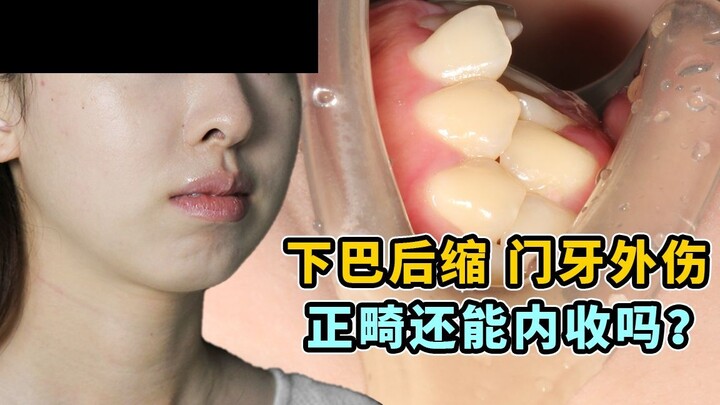 [Girl with Protruding Lips and Traumatized Front Teeth] How Much Does a Severely Receded Chin Affect