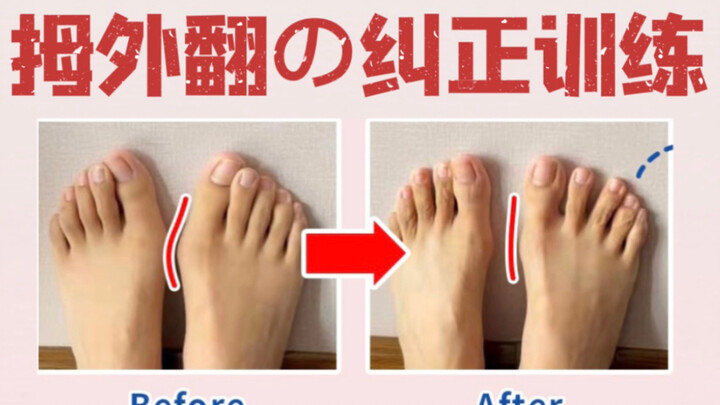 Bài tập tự điều chỉnh vẹo ngón chân cái, tái thiết trục lực chi dưới và củng cố chức năng gan bàn ch