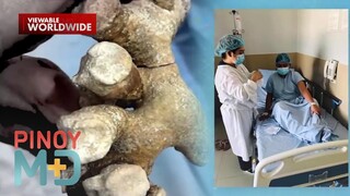 Pagkakaroon ng bato sa kidney, sanhi raw ng labis na pag-inom ng softdrinks?! | Pinoy MD